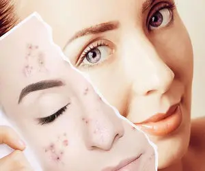 درمان های موثر خانگی لک صورت و بدن چیست؟