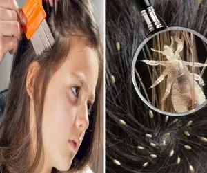 چیکار کنم بچم تو مدرسه شپش نگیره؟ / اگه گرفت هم نزنی تو سر خودت درمان فوریش اینه