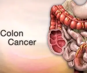 اینفوگرافی؛ به بهانه 14 اسفند روز جهانی آگاهی از سرطان روده