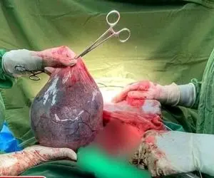کیست سه کیلویی در بدن خانم باردار قمی!