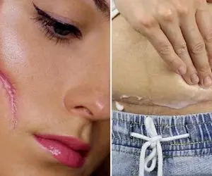 موثر ترین پمادهای ترمیم کننده جای زخم و بخیه؛ مهم نیست صورت باشه یا بدن سریع خوب میشه