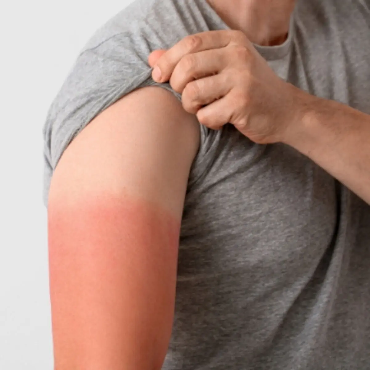 sunburn