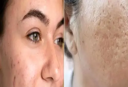 سریع ترین راه از بین بردن جوش های چرکی و سر سفید؛ مختص وقتایی که میخوای بری مهمونی