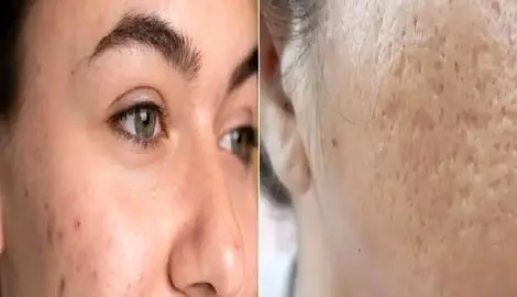 سریع ترین راه از بین بردن جوش های چرکی و سر سفید؛ مختص وقتایی که میخوای بری مهمونی