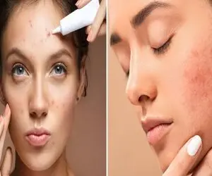 از بین بردن جای جوش در 1 هفته / با این روش جدید که تو اروپا تست شده باهاشون خدافظی کن