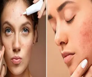 از بین بردن جای جوش در 1 هفته / با این روش جدید که تو اروپا تست شده باهاشون خدافظی کن