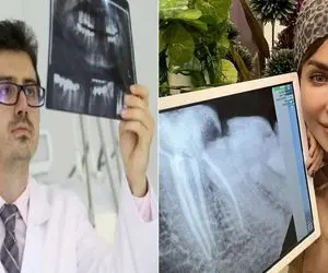 معرفی بهترین دندان‌پزشکان متخصص عصب‌کشی در کرج / دندوناتو بسپر دست اوستاش