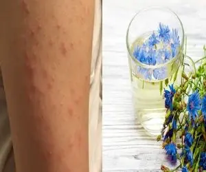 از بین بردن جوش های بازو با روش خانگی و دائمی؛ تنها ظرف چند روز معجزه اش رو ببین