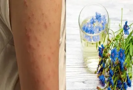 از بین بردن جوش های بازو با روش خانگی و دائمی؛ تنها ظرف چند روز معجزه اش رو ببین