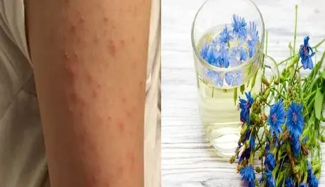 از بین بردن جوش های بازو با روش خانگی و دائمی؛ تنها ظرف چند روز معجزه اش رو ببین