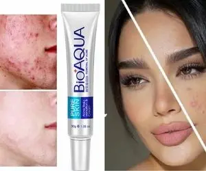 بهترین کرم های ترمیم کننده ی جای جوش / لک؟ قرمزی؟ شوخیت گرفته همشون میشن جزء خاطراتت