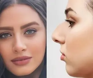 مدل های زیبای بینی گوشتی بعد از عمل؛ با اینا میتونی ببینی دماغتو عمل کنی چه شکلی میشی