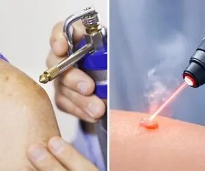 کرایو بهتره یا لیزر؟ از بین رفتن همیشه زگیل تناسلی با انتخاب بهترین روش بسته به اندازه