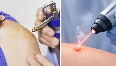 کرایو بهتره یا لیزر؟ از بین رفتن همیشه زگیل تناسلی با انتخاب بهترین روش بسته به اندازه