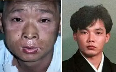 مردی که زنده پوست تنش جدا شد همراه با ترشح اشک خونی! اشعه رادیواکتیو چه میکند!