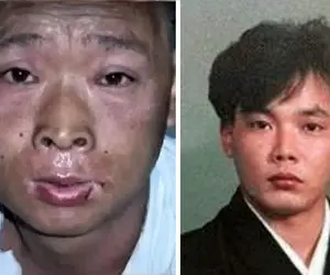 مردی که زنده پوست تنش جدا شد همراه با ترشح اشک خونی! اشعه رادیواکتیو چه میکند!