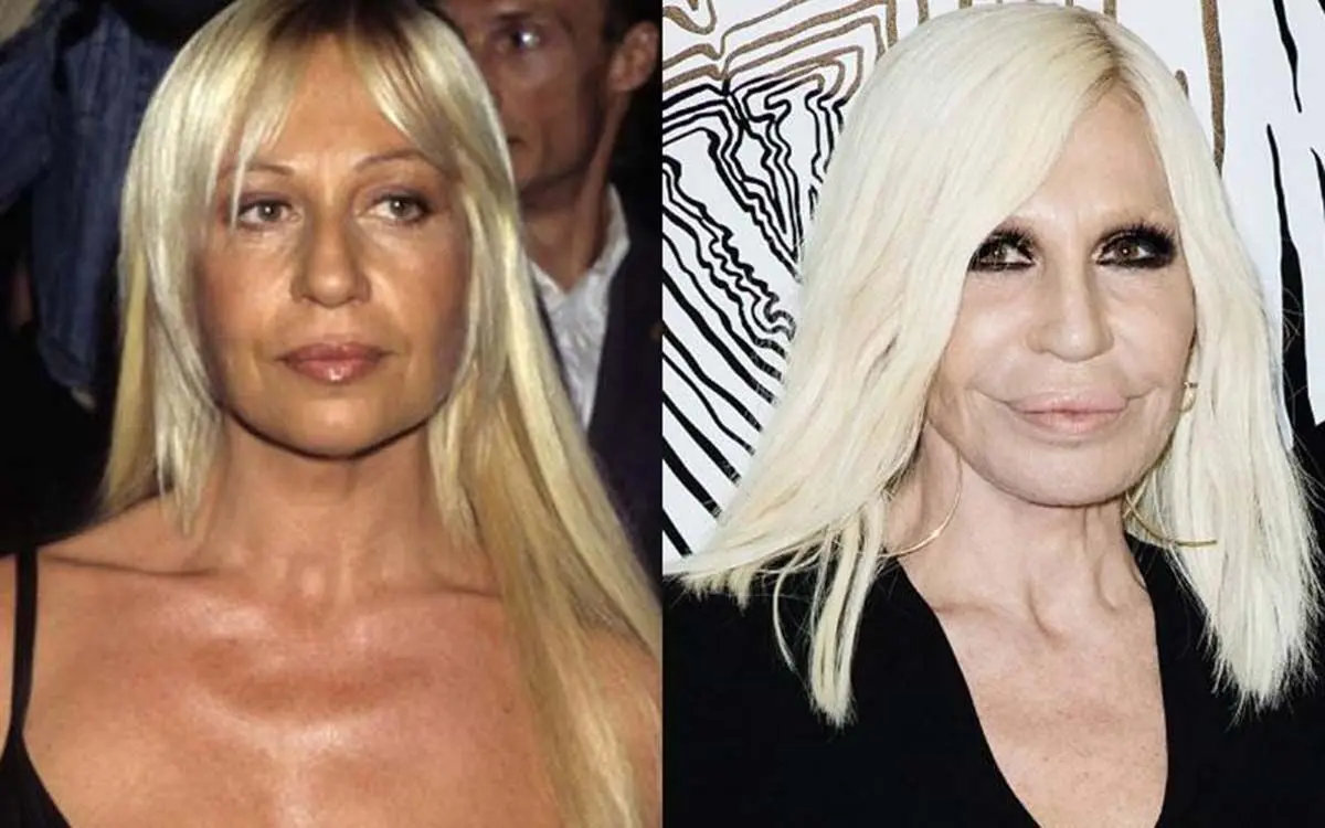donatella-versache-before-after-plastic-surgery-80311