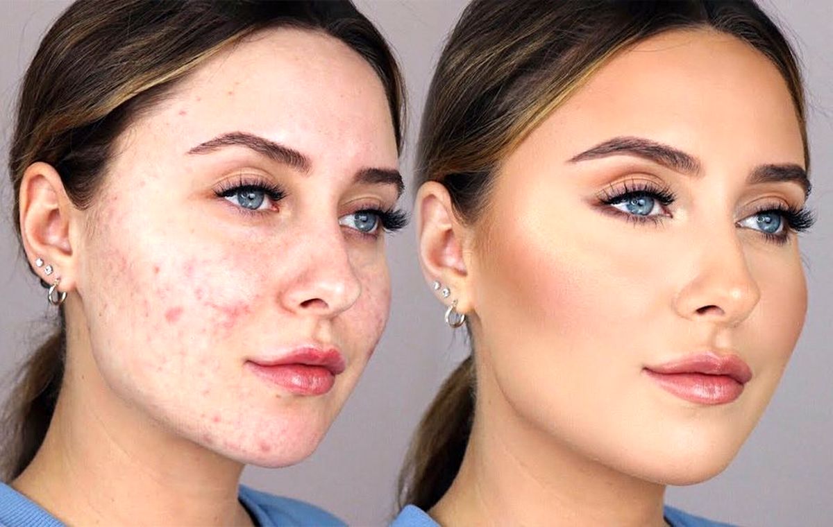 Conceal-Acne-Scars-With-Makeup