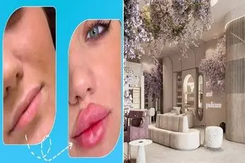 بهترین کلینیک تهران برای تزریق ژل/ حتی اگه لبات خیلی کوچیکن اینجا لب روسی میسازن برات