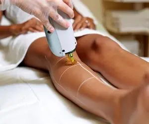 عوارض جانبی لیزر مو‌های زائد چیست؟