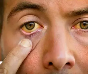 آخرین را نجات برای یرقان؛ شاه داروی گیاهی که کبد و صفرا را آینه می کند!