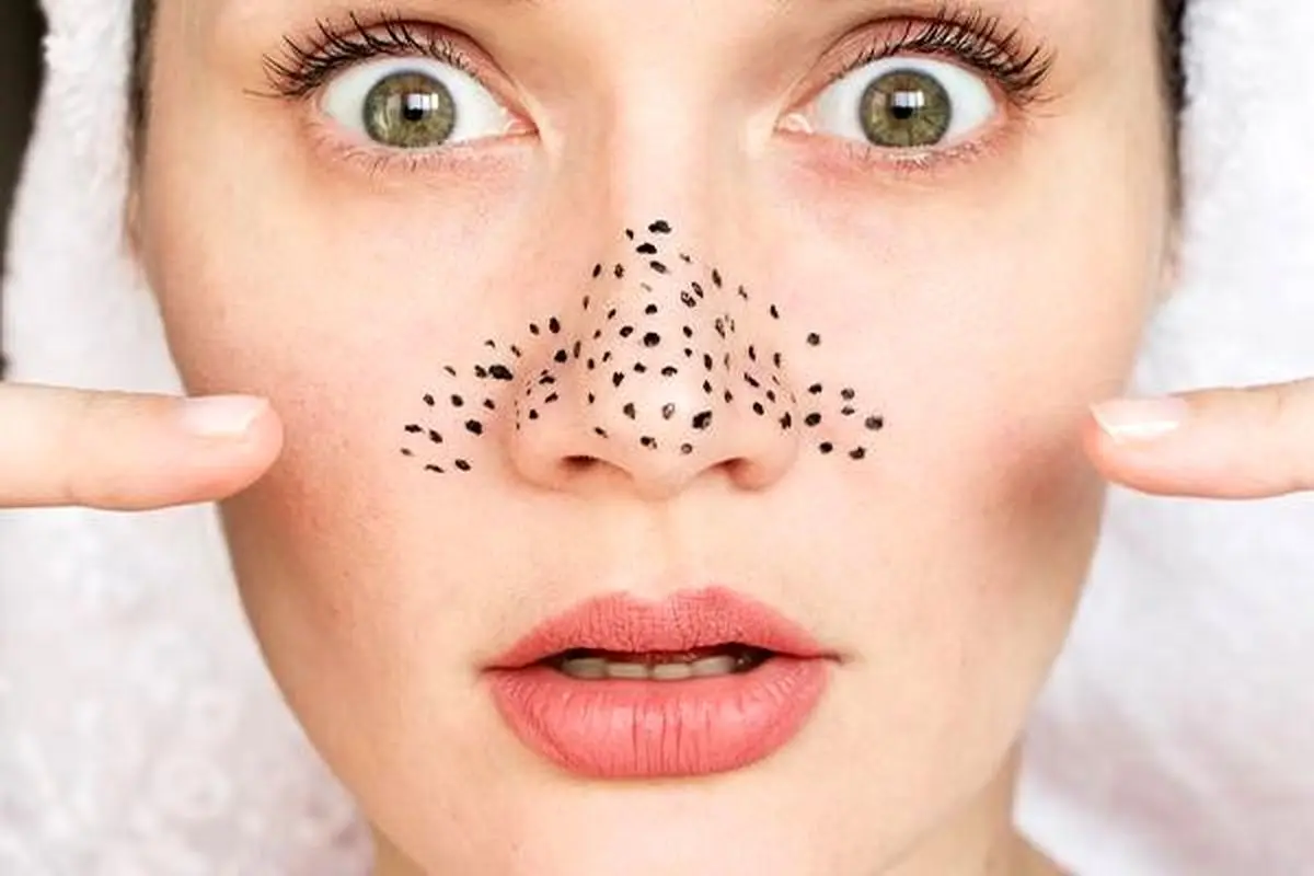 از بین بردن جوش های سرسیاه بینی