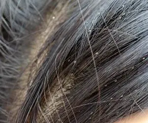  راه پاکسازی شپش کم تر از 20 دقیقه؛ با این داروهای گیاهی از این موجودات بی آبرو رها شووو!