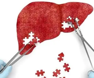 کبد چرب چه علائمی دارد و چگونه درمان می شود؟