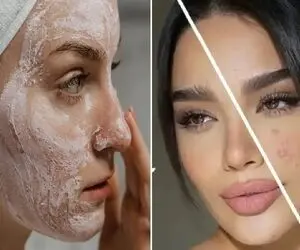 نابودی جوش ها / از هزینه برا از بین بردن جوش هات خسته ای دوای دردت این محلول خونگیه