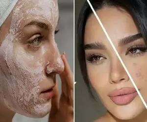 نابودی جوش ها / از هزینه برا از بین بردن جوش هات خسته ای دوای دردت این محلول خونگیه