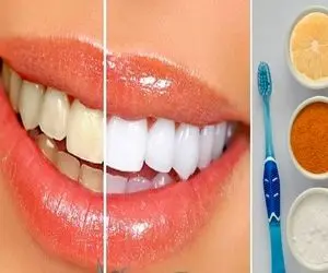 سفید کردن دندون ها با مواد طبیعی و در عرض 20 دقیقه؛ بلیچینگ بی خطر و خونگی
