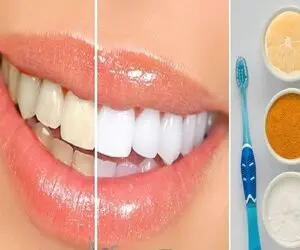 سفید کردن دندون ها با مواد طبیعی و در عرض 20 دقیقه؛ بلیچینگ بی خطر و خونگی