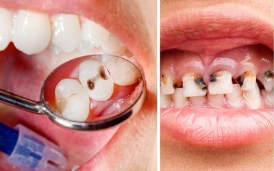 علائم پوسیدگی دندان و روش های خانگی درمان / کمبود این ویتامینا دندان رو پوسیده میکنه
