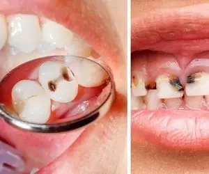 علائم پوسیدگی دندان و روش های خانگی درمان / کمبود این ویتامینا دندان رو پوسیده میکنه
