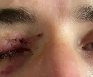 کریم انصاری فرد نزدیک بود یک چشمش کور شود!