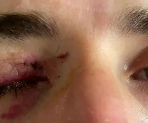 کریم انصاری فرد نزدیک بود یک چشمش کور شود!