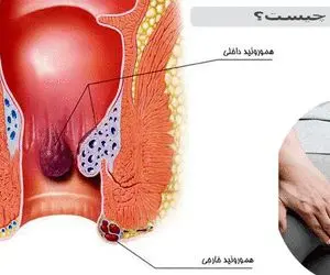 هموروئید داخلی و خارجی و روش‌های درمان