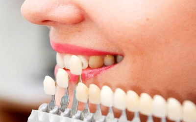 کامپوزیت دندان بهتر است یا لمینت سرامیکی؟