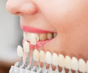کامپوزیت دندان بهتر است یا لمینت سرامیکی؟