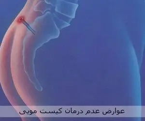 کیست مویی چیست؟ درمان کیست مویی با جراحی یا لیزر؟