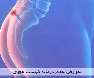 کیست مویی چیست؟ درمان کیست مویی با جراحی یا لیزر؟