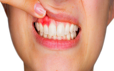 ۱۰ درمان خانگی برای آبسه دندان