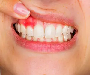 ۱۰ درمان خانگی برای آبسه دندان