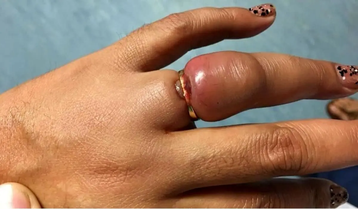 how-to-remove-a-ring-from-a-finger0