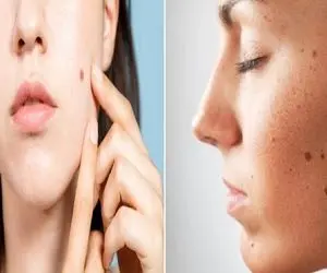 از بین بردن خال های صورت و بدن در خانه و با استفاه از مواد طبیعی؛ با سرکه سیب حلش کن