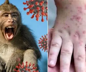 شیوع ام پاکس در انسان/ آبله میمونی چگونه گسترش یافت؟