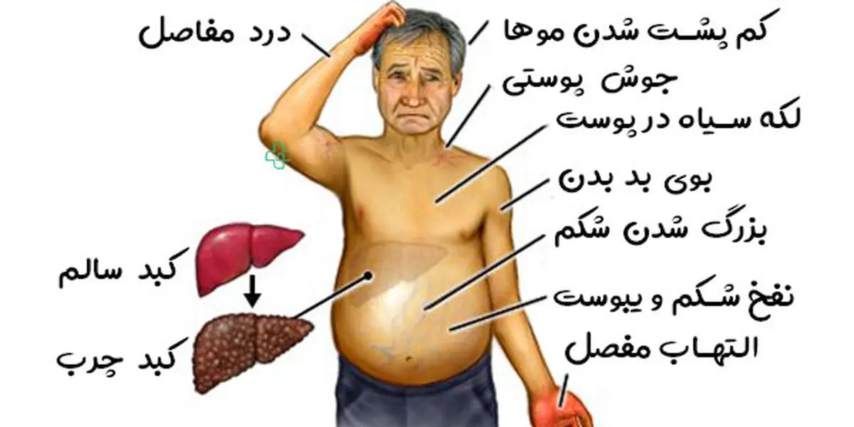 علائم-کبد-چرب-گرید-1