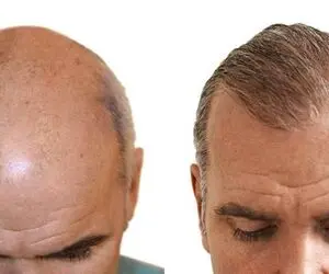همه چیز درباره کاشت مو؛ از عوارض تا معایب