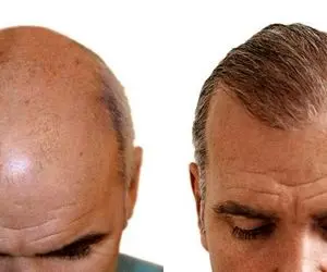 همه چیز درباره کاشت مو؛ از عوارض تا معایب