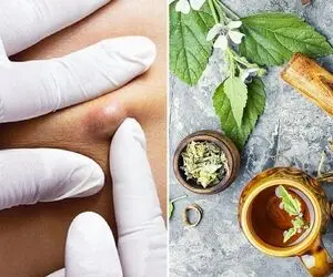 از بین بردن جوش های ران پا با ترفند راحت؛ با یکم از این روغن پاهاتو صاف صاف کن
